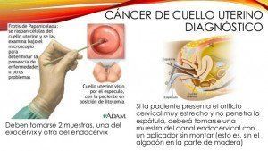 Diagnostico de cancer de cuello uterino