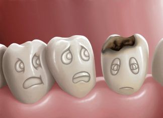 Evitar las caries con 3 consejos esenciales