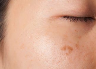 Consejos naturales para deshacerse de las manchas en la piel por la edad