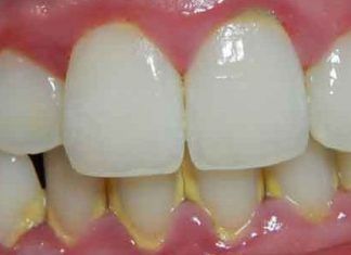 quitar manualmente el sarro