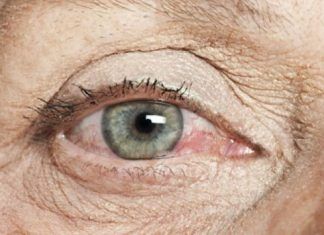 síndrome del ojo seco