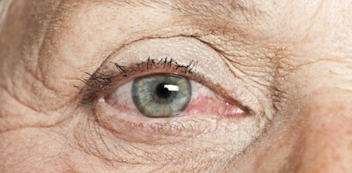 síndrome del ojo seco