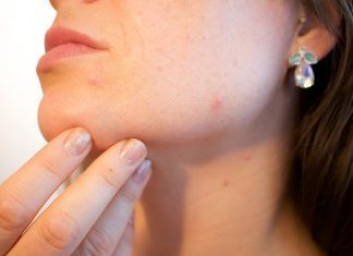Elimina el acné es una de las frases más llamativas para mujeres y hombres.