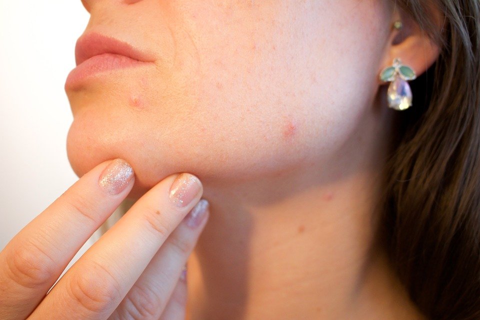 Elimina el acné es una de las frases más llamativas para mujeres y hombres.