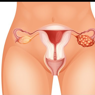 FXPOI o pérdida de la función normal de los ovarios