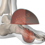 Ácido úrico alto puede ocasionar gota
