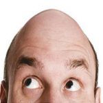 Calvicie o pérdida del pelo en hombres y mujeres ¿Por qué ocurre? Calvicie o pérdida del cabello