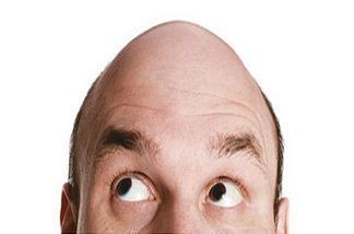 Calvicie o pérdida del pelo en hombres y mujeres ¿Por qué ocurre? Calvicie o pérdida del cabello