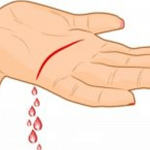 Shock Hipovolémico: implicaciones cuando se pierde sangre