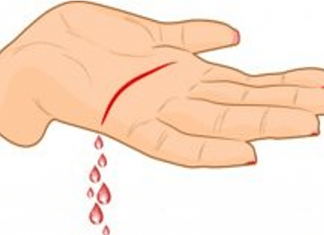 Shock Hipovolémico: implicaciones cuando se pierde sangre