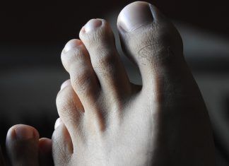 Los hongos producen mal aspecto en quien los porta y por ello es importante combatirlos a tiempo.