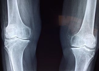 Conozca los peligros de consumir glucosamina La glucosamina, es una sustancia natural que se extrae de los cartílagos sanos. Las personas con artritis u osteoartritis, necesitan de esta sustancia para ayudar a reconstruir y reparar aquellos cartílagos que estén rotos. La glucosamina regularmente se toma junto a la condroitina, que ayuda a reducir los niveles de inflamación. Primero se debe tener en cuenta, que antes de empezar a tomar cualquier clase de fármaco. Se debe consultar con el médico especialista; de esta manera se asegurará que realmente se necesita tomarlo, o si habrá que añadir otro medicamento al tratamiento, de acuerdo a las necesidades del paciente.