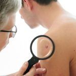 Desarrollo del cáncer de piel: debemos prevenirlo desde los 6 meses Desarrollo del cáncer de piel