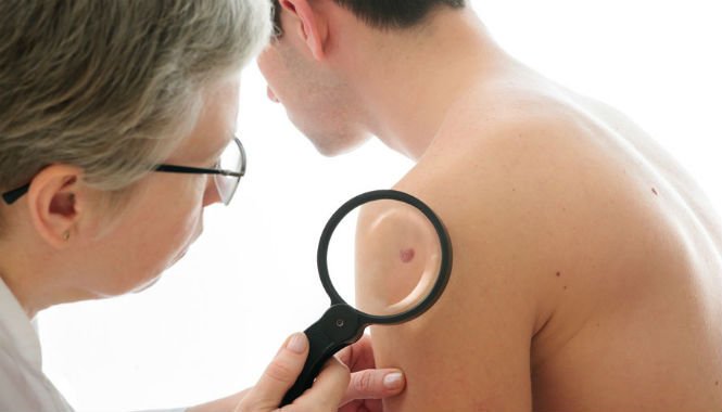 Desarrollo del cáncer de piel