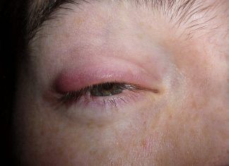 Orzuelos, esos pequeños e incómodos abscesos en el párpado orzuelos