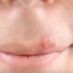Herpes labial