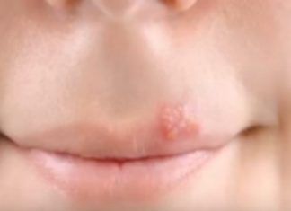 Herpes labial