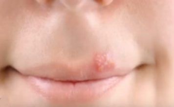 Herpes labial