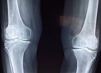 Rodilla hinchada