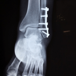 Fracturas por estrés