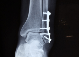 Fracturas por estrés
