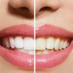 Blancura de los dientes