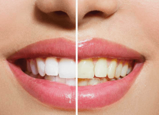 Blancura de los dientes