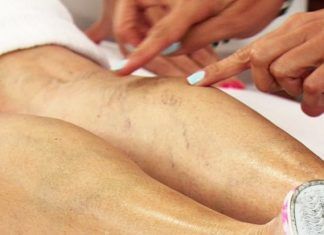 Varices. Créditos: Flickr