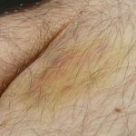 Hematomas que cambian de color, la explicación a este hecho