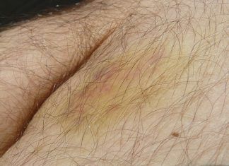 Hematomas que cambian de color, la explicación a este hecho