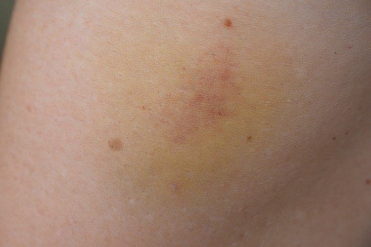 Hematomas que cambian de color, la explicación a este hecho