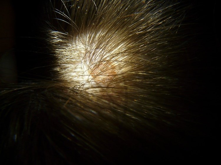 Tratar y controlar la psoriasis del cuero cabelludo