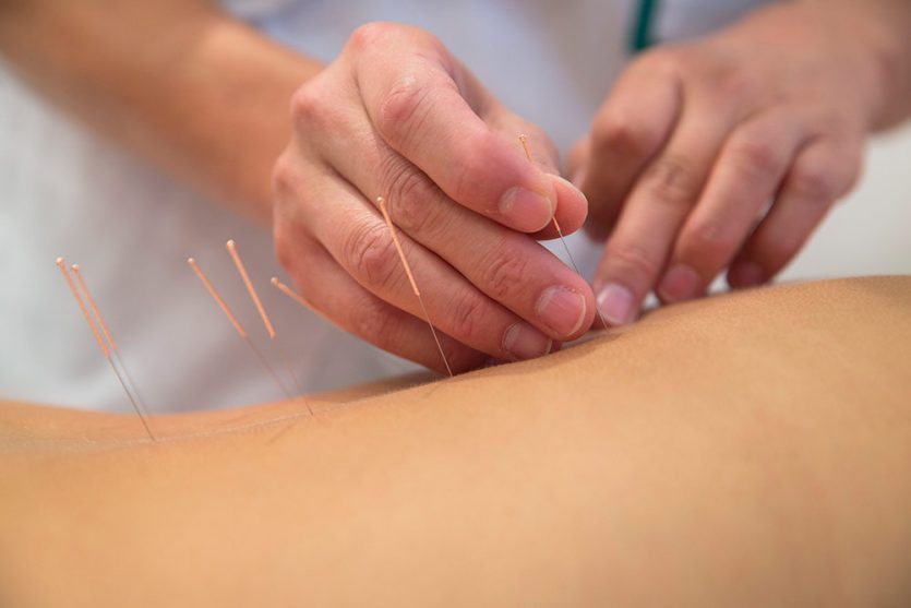 La acupuntura es el método más popular de la Medicina China