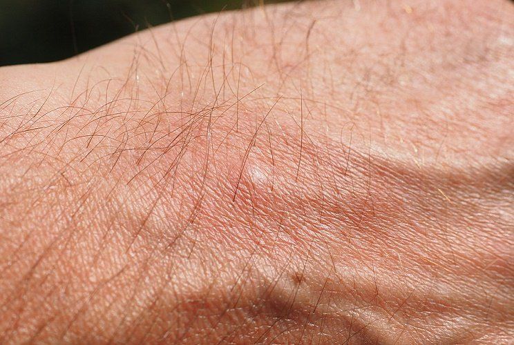 Aliviar la molestia de las picaduras de mosquitos de forma sencilla