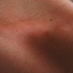 La Dermatoscopia digital