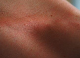 La Dermatoscopia digital