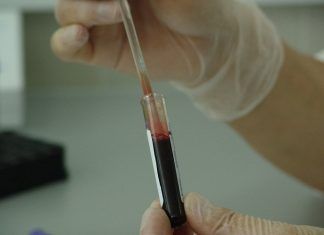 Plasma rico en plaquetas para tratar disfunciones sexuales en las mujeres