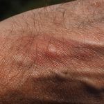 Razones por las que nos rascamos