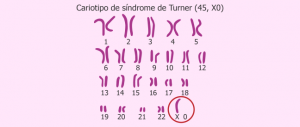cariotipo del síndrome de Turner 