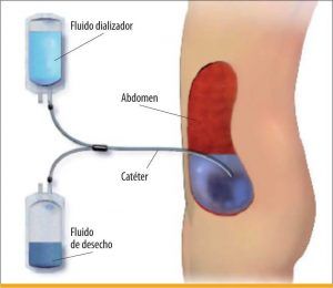 diálisis peritoneal