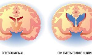 Conoce la Enfermedad de Hunghtinton