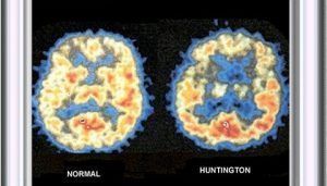Conoce la Enfermedad de Hunghtinton