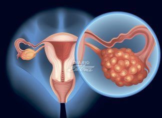 Síndrome de Ovario Poliquísticos