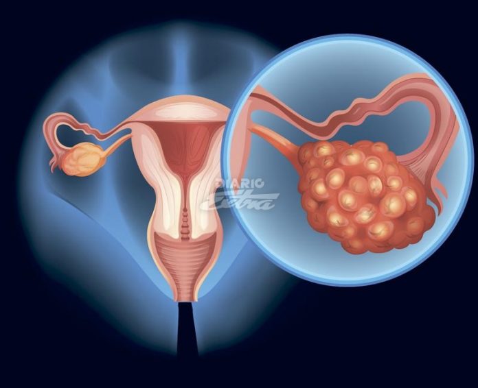 Síndrome de Ovario Poliquísticos