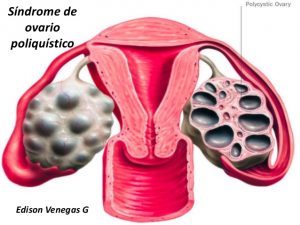 Síndrome de Ovario Poliquísticos