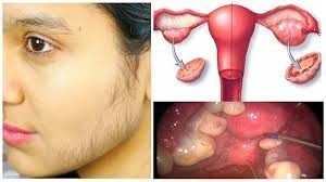 Síndrome de Ovario Poliquísticos