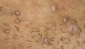 Las Verrugas en los Genitales.