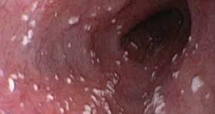 Candida auris