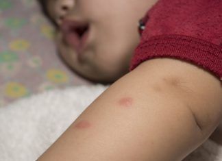 picaduras de arañas