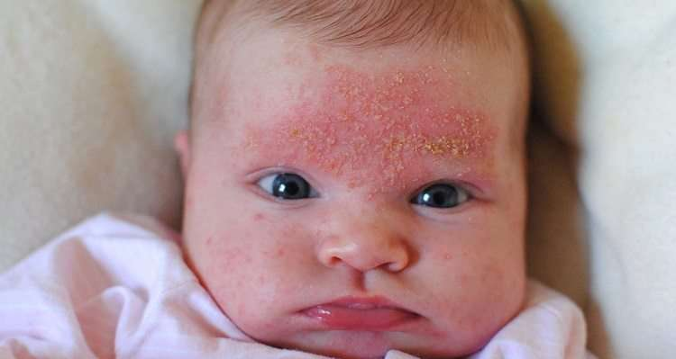 Irritaciones en la piel de bebés / / ellahoy.es